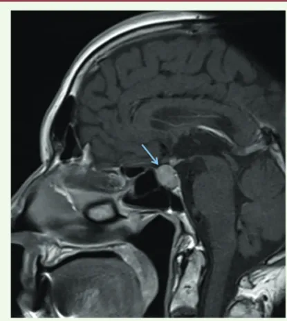 Figure 4. Hypophysite auto-immune apparue sous anticorps anti-CTLA-4 (col- (col-lection M