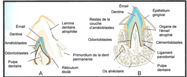 Fig. 14: A : Dent primaire en formation chez le foetus. B; Dent primaire partiellement éruptée chez le nouveau-né
