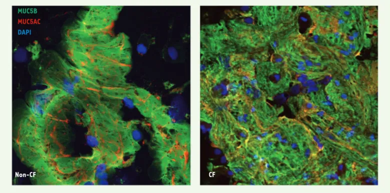 Figure 2. Images représentatives de flocons de mucus obtenues par immunohistofluorescence à partir des BALF d’enfants avec (CF) ou sans (non- (non-CF) mutation de CFTR