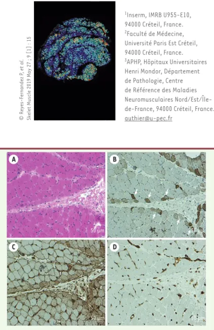 Figure 1.  Dermatomyosite : Biopsie musculaire. (A) Atrophie périfasciculaire et  collagénolyse septale (H&amp;E)