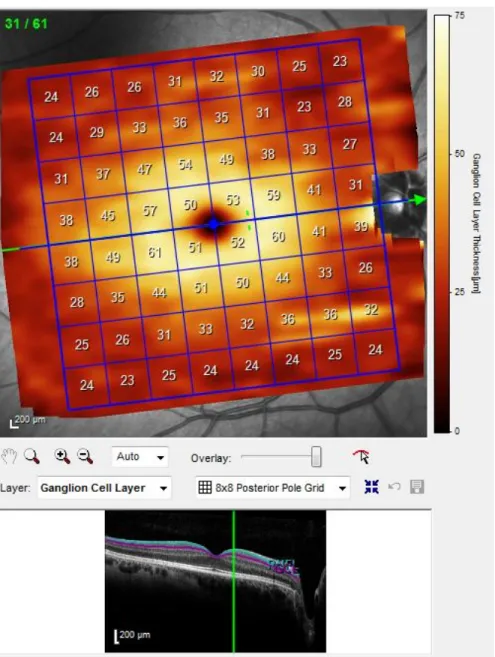 Figure 5. Example of GCL layer acquisition on Spectralis OCT 