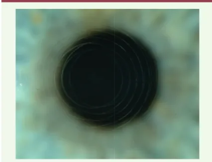 Figure 1. Correction de presbytie par laser femtoseconde intracornéen.