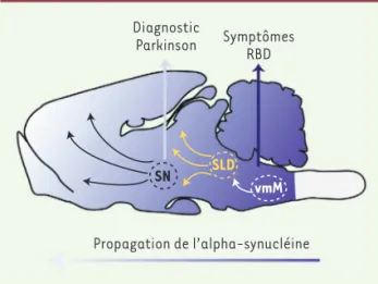 Figure 2. Hypothèse sur les mécanismes physiopathologiques sous-jacents à  la phénoconversion du RBD en maladie de Parkinson