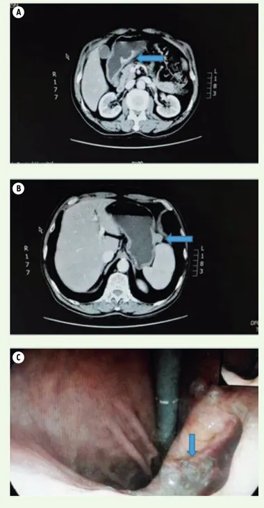 Figure 1. CT and gastroscopy indicate GC with GIST. (A) CT indicates an ulcerated  GC lesion in the gastric antrum; (B) CT indicates an exogenous stromal tumor in  the gastric fundus; (C) Gastroscopy revealed a large ulcer in the gastric antrum