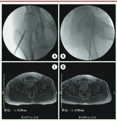 Figure 1. Bone marrow core decompression and calcium sulfate artificial bone  implantation of pre-operative and post-operative imaging comparison