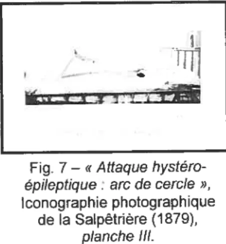 Fig. 7 — « Attaque hystéro épileptique t arc de cercle », Iconographie photographique de la Salpêtrière (1879), planche III