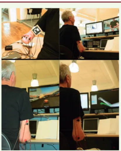 Figure 2. Système de réalité virtuelle combinant l’activité élec- élec-tromyographique et le principe de la thérapie en miroir chez un  patient amputé pour lutter contre les douleurs liées au membre  fantôme (d’après [7])