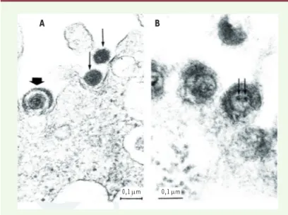 Figure 2.  Particules rétrovirales et herpétiques co-exprimées après infection  par HSV-1 de cultures de cellules provenant de patients atteints de sclérose  en plaques