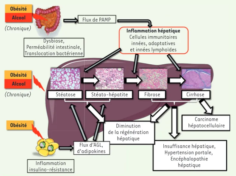 Figure 1.  Les maladies  métaboliques chroniques du  foie : ALD (alcoholic liver  disease) et NAFLD  (non-alcoholic liver disease)  par-tagent des traits communs
