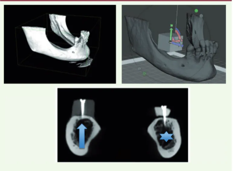 Figure 1.  Réalisation d’un subs- subs-titut osseux sur mesure par  fabrication additive en PLA  de grade médical à partir d’un  fichier d’imagerie  tridimention-nelle