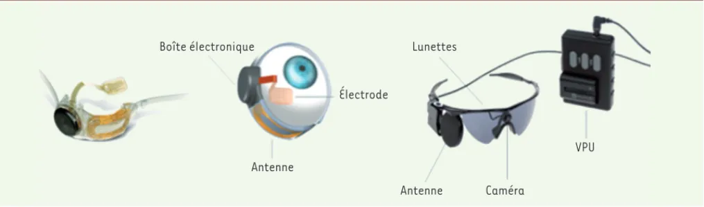 Figure 1. Implant épi-rétinien et système de recueil de données fixé aux lunettes de la société Second Sight