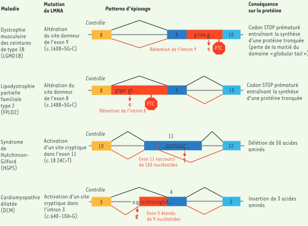 Figure 3. Des altérations de l’épissage d’un même gène peuvent être la cause d’une même maladie : Exemple du gène LMNA