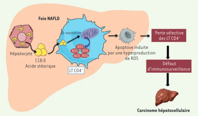 Figure 1. La perte sélective des  lymphocytes T CD4+ dans les  hépatopathies stéatosiques dites  non-alcooliques (NAFLD)  favo-rise le développement de  car-cinome hépatocellulaire