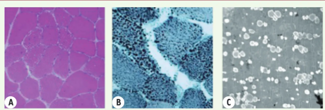 Figure 1.  Biopsie musculaire (jambier antérieur). Coloration HES (A), Noir Soudan (B) et  microscopie électronique (C) : surcharge lipidique majeure.