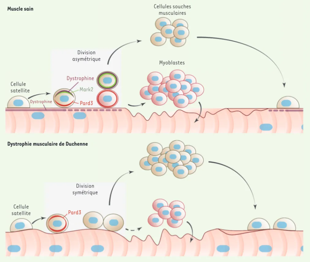 Figure 1. Conséquences des déficits intrinsèques des cellules satellites dans la dystrophie musculaire de Duchenne (DMD)