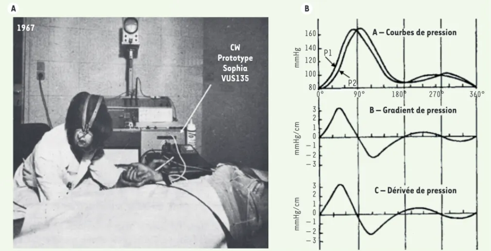 Figure 1. A. Premiers essais d’enregistrement des courbes de vélocité artérielle instantanée en mode Doppler directionnel grâce au prototype Sophia  VUS 135, à partir de 1966, ici en 1967