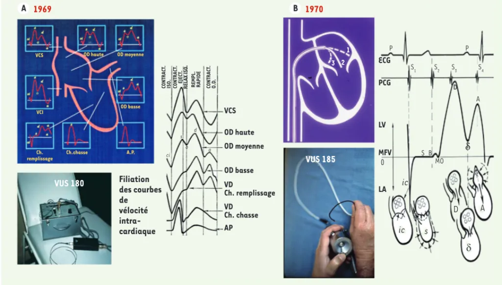 Figure 2. A. 1969 : en haut à gauche, le Sophia VUS 180, premier cathéter Doppler vélocimétrique directionnel des cavités droites