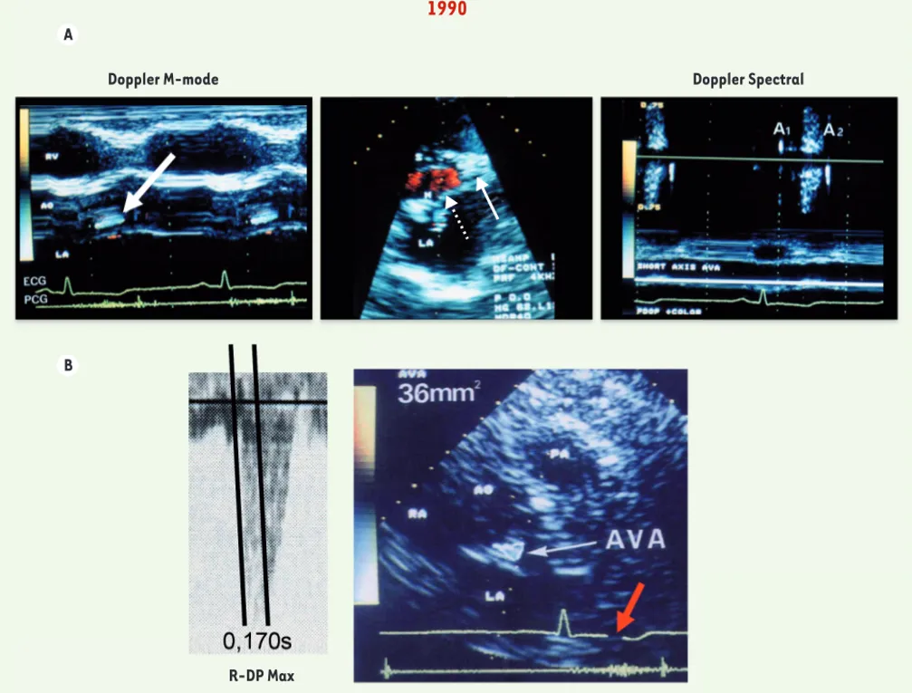 Figure 5. 1990, avantages du Doppler pulsé à codage coloré, nouveaux critères physiopathologiques déterminant où et quand planimétrer une  surface sténosée (ici sténose aortique)
