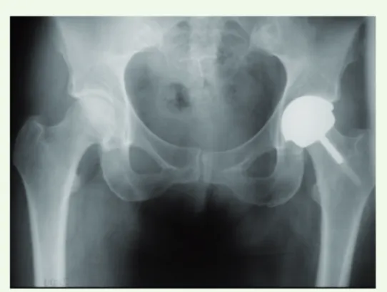 Figure 2. Radiographie de bassin avec un resurfaçage de hanche (d’après [2]).