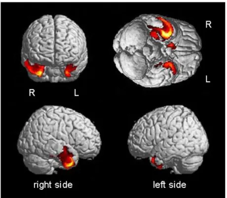 Figure  3a.  Common  local  grey  matter  atrophy  observed  in  the  group  of  3  patients  compared  to  28  healthy  age-matched  controls  using  voxel-based  morphometry  (VBM)