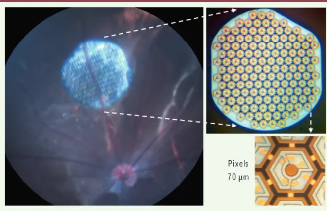 Figure 1. Implant photovoltaïque sous-rétinien. A. Image de fond d’œil d’un rat implanté avec la  prothèse sous-rétinienne (A, Image © Julie Dégardin) constituée de 143 pixels sur un implant de 1  mm de diamètre (B)