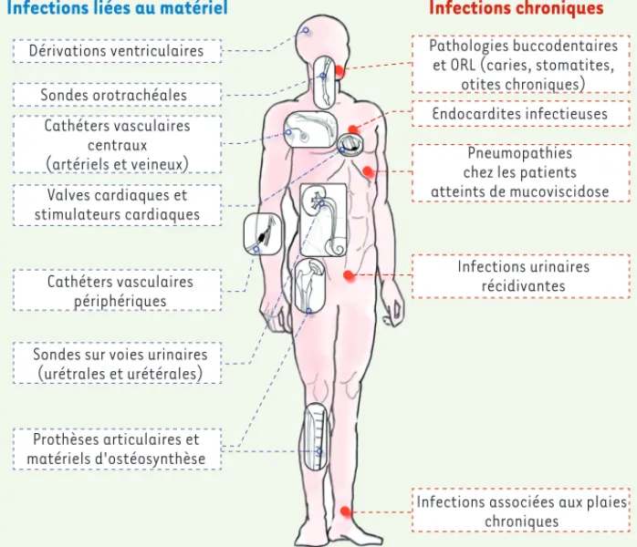 Figure 4. Principales infections associées aux biofilms. ORL : oto-rhino-laryngologie.