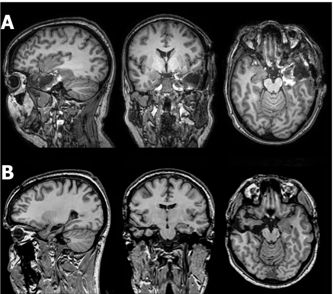 Figure  2.  Post-operative  T1-weighted  sagittal,  coronal,  and  axial  MRI  scans  from  representative  cases  of  the  temporal  group