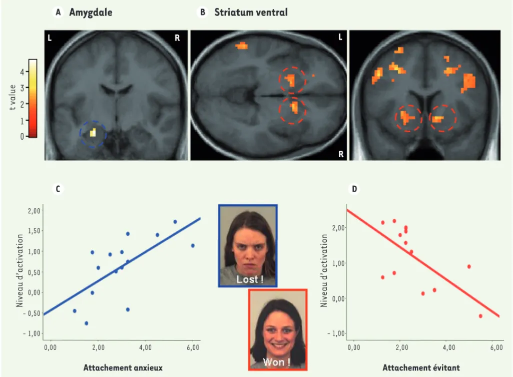 Figure 3.  Effets de traits de personnalité chez des sujets sains.  A. Activation de l’amygdale lorsque des visages exprimant la colère sont pré- pré-sentés suite à une erreur lors d’une tâche cognitive, et (B) du striatum ventral lorsque des visages expri