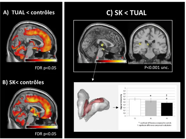 Figure 7 : Atteintes cérébrales structurales de la substance grise (SG) chez les patients  TUAL et SK