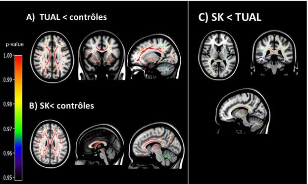 Figure 8 : Atteintes cérébrales de la substance blanche (SB) chez les patients TUAL et  SK