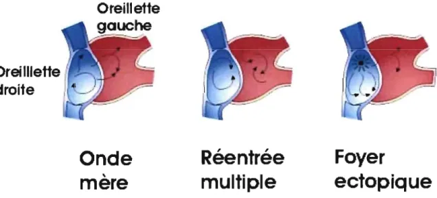 Figure  6 :  Illustration  schématique  des  3  types  de  mécanisme  de  fibrillation  auriculaire