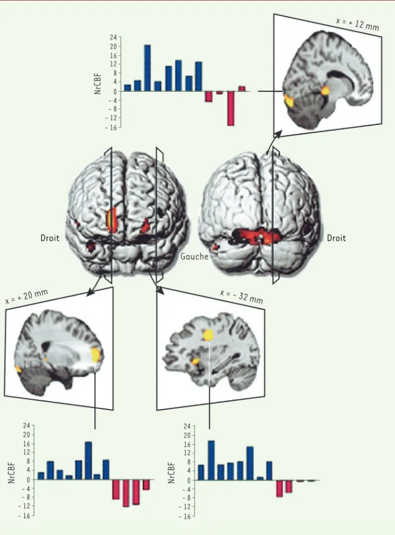 Figure 2. Neuro-imagerie de l’apprentissage de l’inhibition. L’une des activations cérébrales les plus importantes qui  différencient l’apprentissage à l’inhibition du mode de raisonnement erroné par rapport à un apprentissage  stric-tement logique est le 