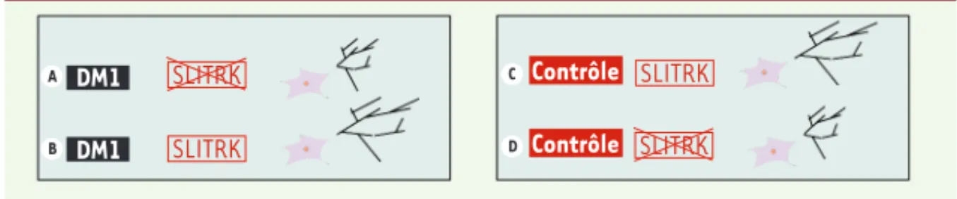 Figure 2. Lien causal entre le défaut d’arborisation neuritique et le défaut d’expression de deux gènes de la  famille SLITRK dans les progéniteurs neuraux issus de cellules CSEh DM1