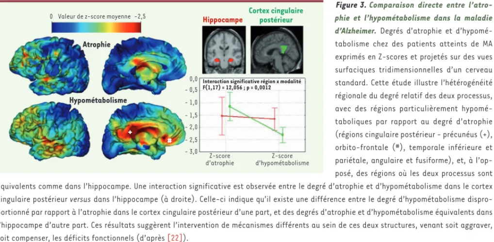 Figure 3. Comparaison directe entre l’atro- l’atro-phie et l’hypométabolisme dans la maladie  d’Alzheimer