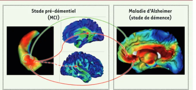 Figure 4. Modèle illustrant les relations  potentielles de cause à effet entre atrophie  et fonctionnement cérébral