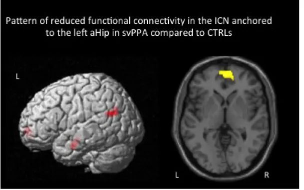 Figure 2. Pattern of decreased rs-fcMRI in the network anchored to the left aHip in svPPA compared  to CTRLs (p ≤ .05 FDR corrected at cluster level)