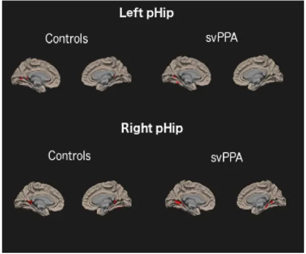 Figure 4. Above: rs-fcMRI network anchored to the left posterior hippocampal seed in CTRLs and  svPPA
