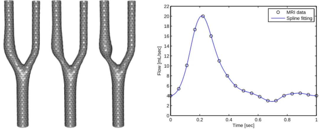 Figure 4. Carotid bifurcation: healthy (left), 30% (middle), 64%