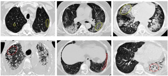 Figure 1.2. Images CT pulmonaires contenant des changements radiologiques associés à la présence de maladies pulmonaires
