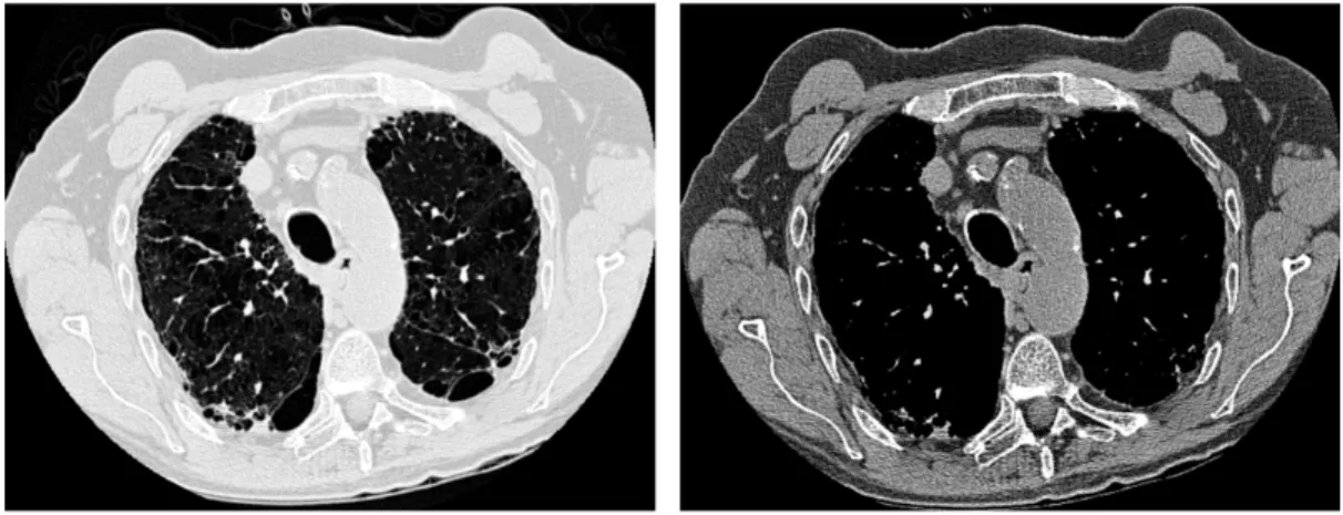 Figure 2.3. À gauche, une coupe axiale de poumons est affichée avec un fenêtrage pulmonaire (centre de −400 HU, largeur de 1200 HU)