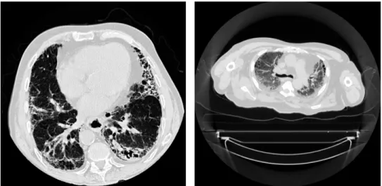 Figure 2.4. Images de patients atteints de fibrose pulmonaire provenant de bases de données haute résolution (à gauche, champ de vue de 336 mm) et de radio-oncologie (à droite, champ de vue de 600 mm)