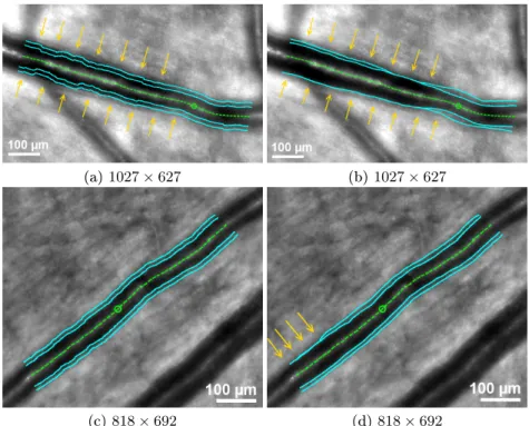 Fig. 2: Limits of the pre-segmentation (a,b) and the parallel snake model (c,d) for two distinct pathological subjects