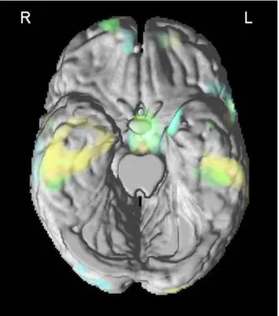 Figure 3. VBM results superimposed to the 3-D rendering of the standard MNI brain  without cerebellum showing the involvement of the temporal regions in aMCI-SD  (green), aMCI-MD (yellow) and mild AD (light blue) compared to the control group