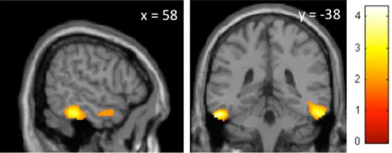 Fig 1. Effects of sleep deprivation on brain perfusion patterns during wakefulness in sleepwalkers compared to controls