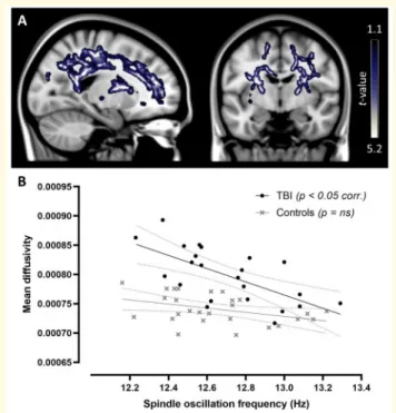 Figure 3 Sleep spindle oscillation frequency and white matter damage. (a) Brain regions (blue-grey) in the TBI group where lower spindle oscillation frequency is correlated with higher mean diffusivity (r ¼ 0.66; thresholded at P &lt; 0.05; corrected for a