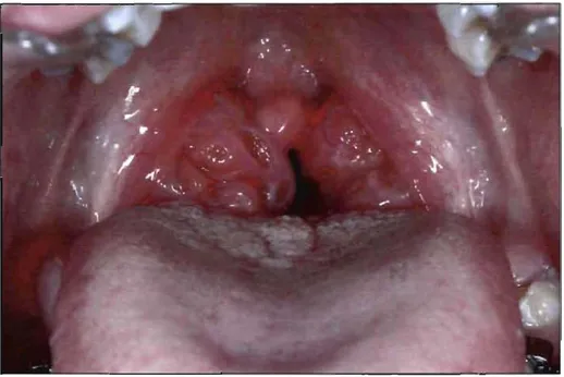 Figure 3. Tonsillar hypertrophy and  pharyngeal airway obstruction in an  adolescent orthodontie patient 