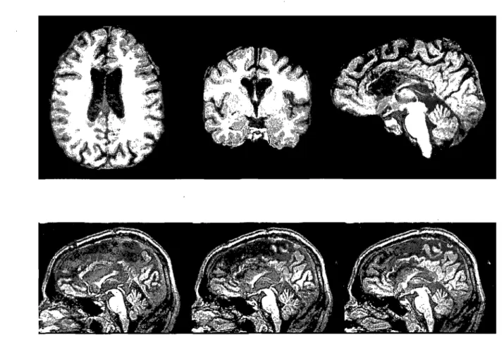 Figure  la:  Post-operative MRI brain images of the split-brain patient M.L. 