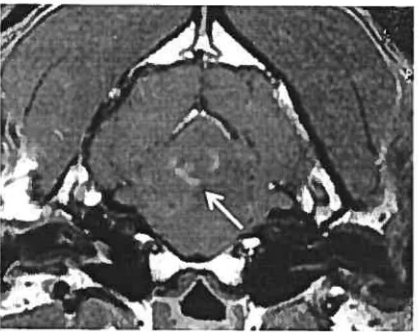 Figure 5. Astrocytome (même que figure 4). Image axiale (transverse), pondération en TI suite à l’administration intraveineuse de gadopentétate de diméglumine