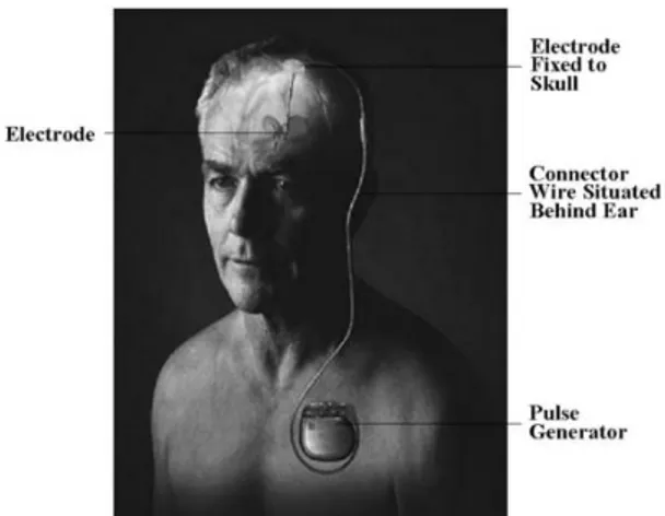 Figure 1 : Illustration de la stimulation  cérébrale profonde (1) 