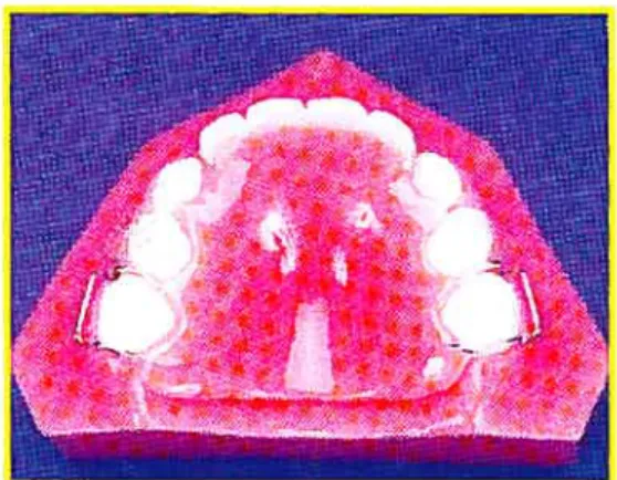 Figure 1: Prothèse partielle amovible